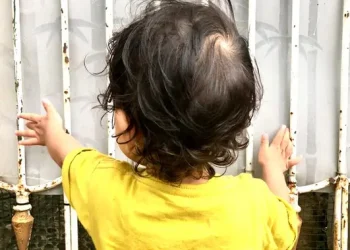 17 Anak Meninggal Akibat Campak di Sumenep Menunjukkan Pentingnya Imunisasi