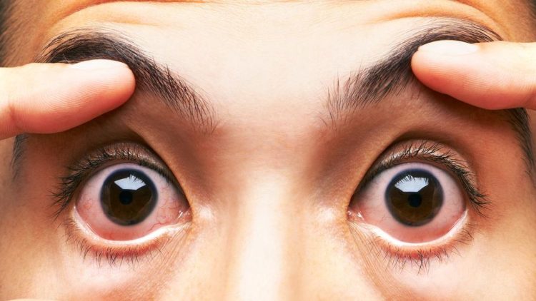 Kentut Bisa Bikin Mata Merah, Apa Benar Itu?