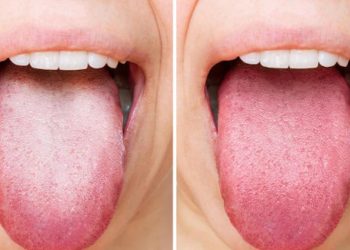 Warna Lidah Sebagai Cermin Kesehatan Tubuh dan Cara Mengenalinya