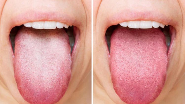 Warna Lidah Sebagai Cermin Kesehatan Tubuh dan Cara Mengenalinya