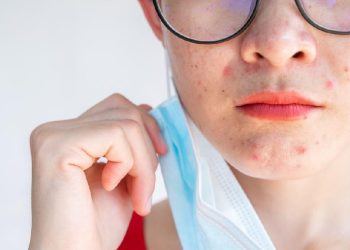 Kesehatan Mental yang Terganggu Dapat Menyebabkan Jerawat Bandel di Wajah