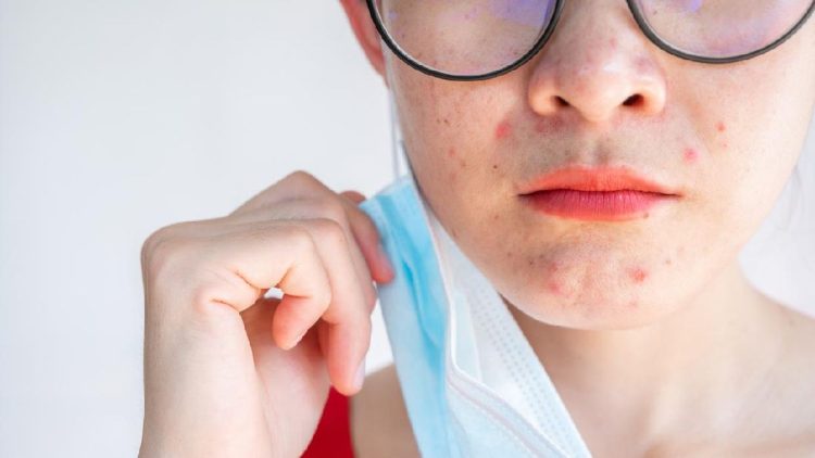 Kesehatan Mental yang Terganggu Dapat Menyebabkan Jerawat Bandel di Wajah