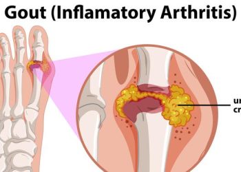 Mengenal Tofi pada Penderita Asam Urat, Gejala dan Penanganannya